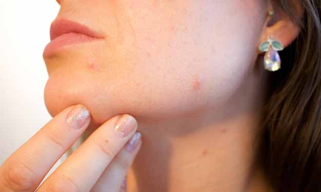 Woman with Acne on Face and Neck.