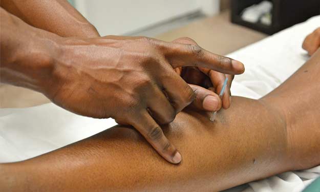 Man Having Acupuncture to Arm Area.