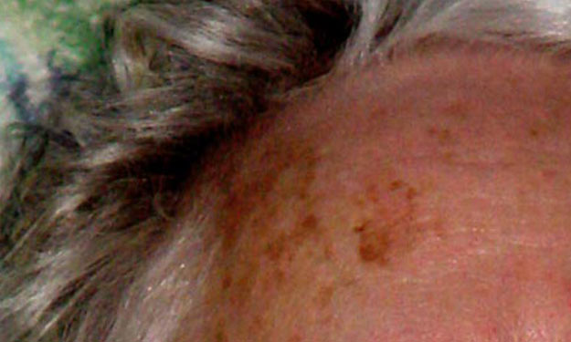 Age Spots on Womans Forehead.