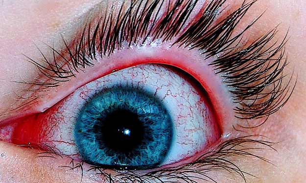 Close Up of Woman's Eye with Conjunctivitis.
