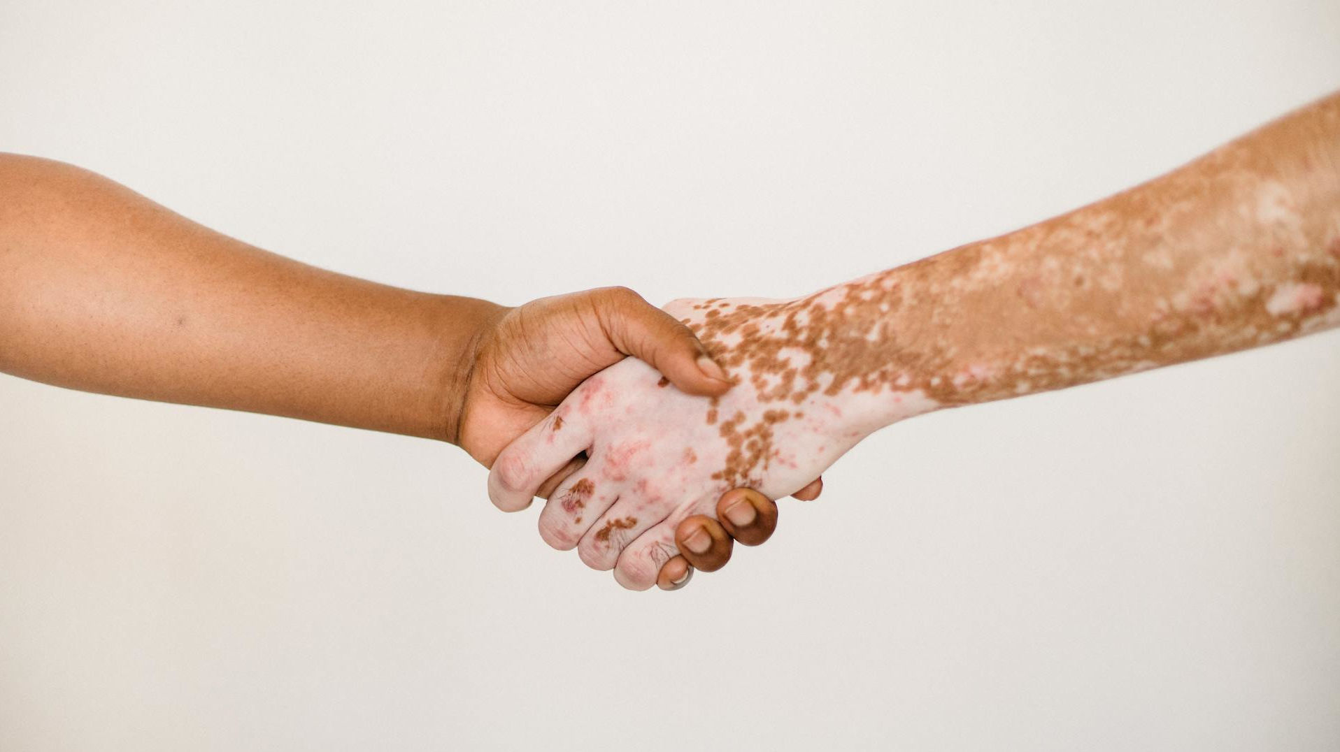 Vitiligo